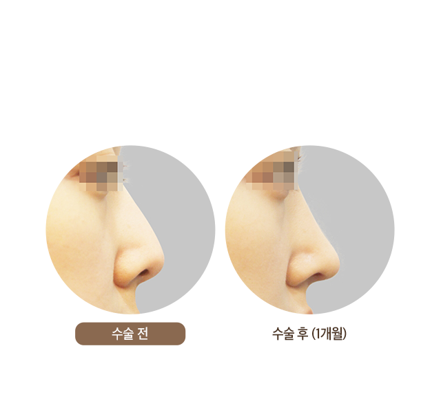 수술 후 (1개월)