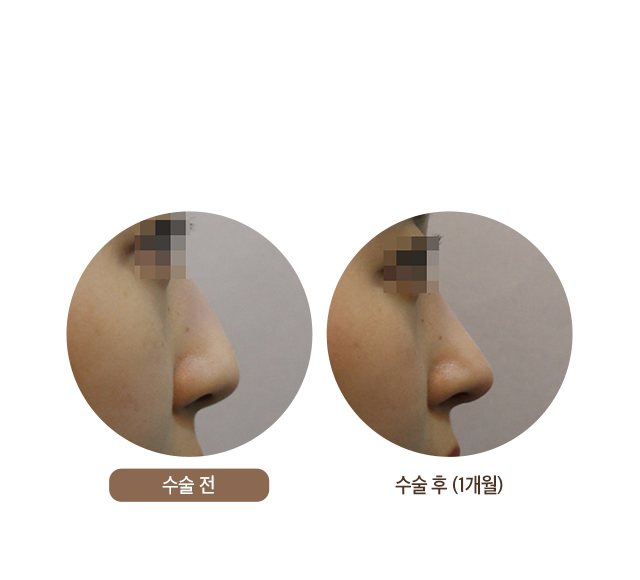 수술 후 (1개월)