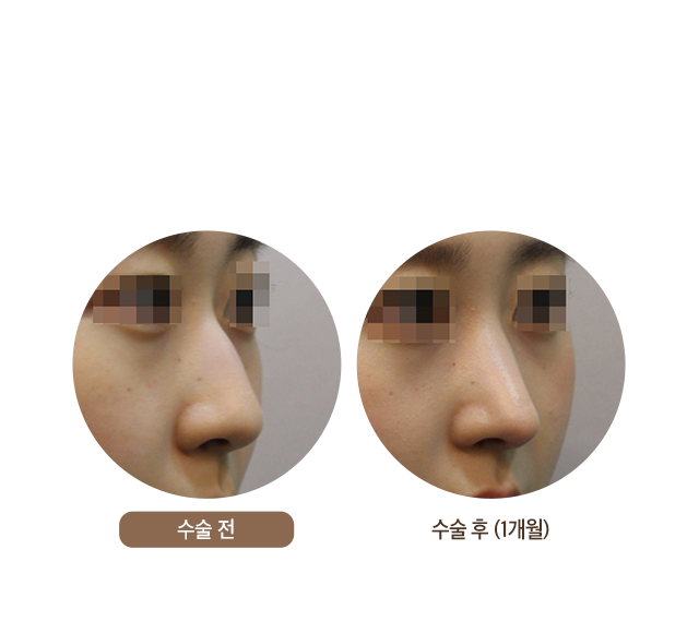 수술 후 (1개월)