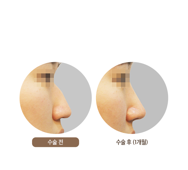 수술 후 (1개월)