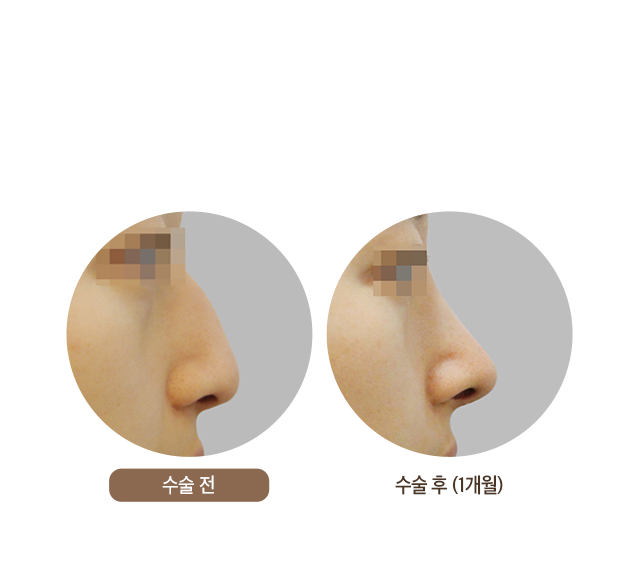 수술 후 (1개월)