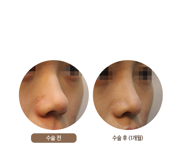 수술 후 (1개월)