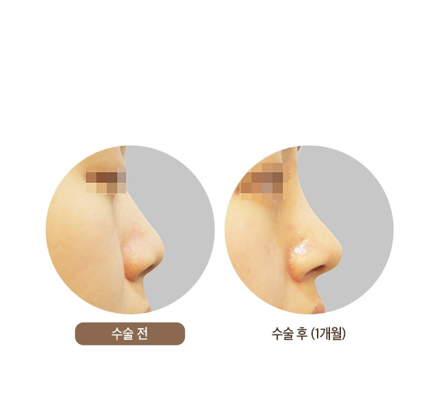 수술 후 (1개월)