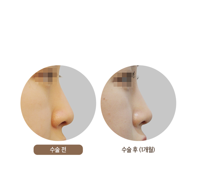 수술 후 (1개월)